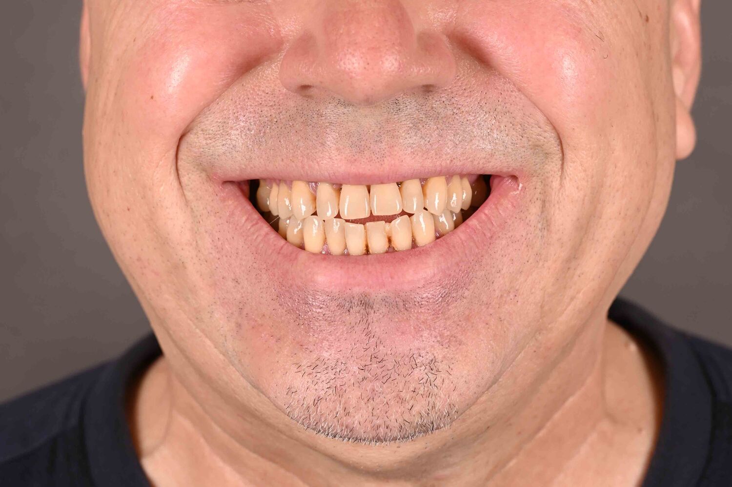 Pacient Clinica Dr. Alin Odor - Rezultat Implantologie